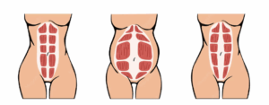que es la diastasis abdominal 